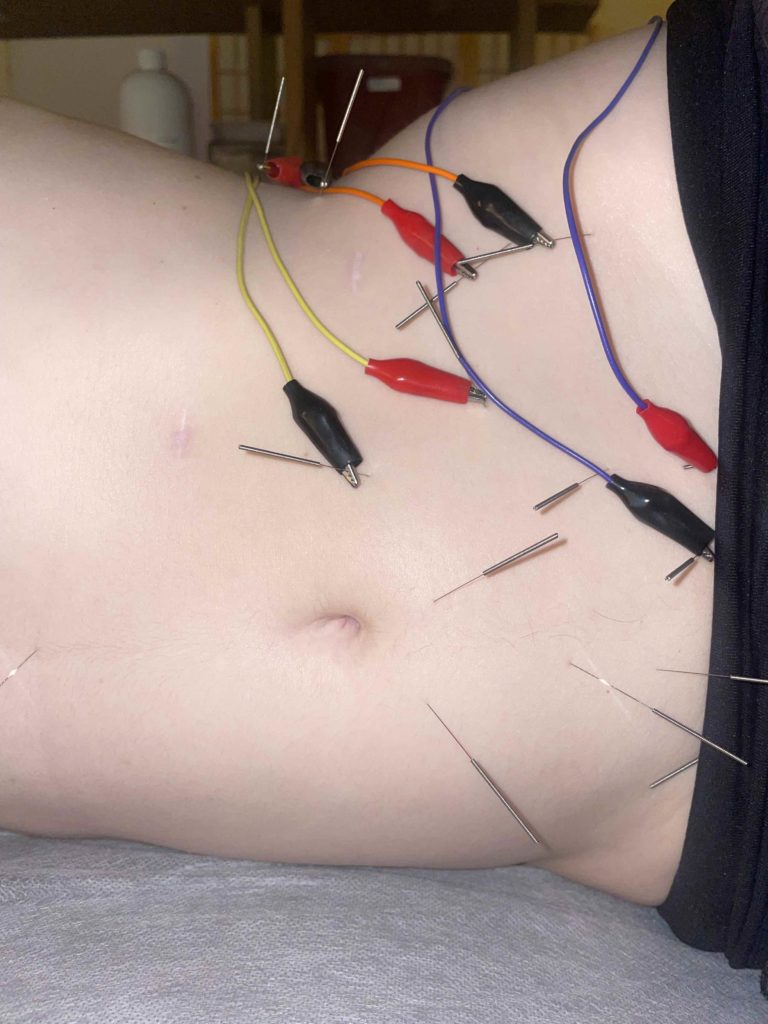 A close up of a white person’s midsection while they are laying on their side. They have needles inserted into their abdomen and some of the needles have colorful ESTIM cables connected to them so an electrical current can be run between two points.